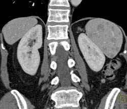 Sarcoidosis - CTisus CT Scan