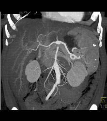 Splenic Hemangiomas - CTisus CT Scan