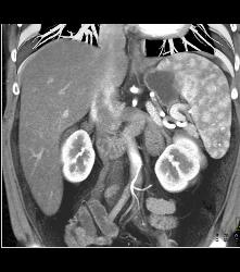 Normal Moire Spleen - CTisus CT Scan