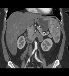 Splenic Hemangiomas - CTisus CT Scan