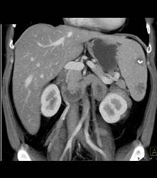 Splenic Hemangiomas - CTisus CT Scan