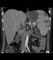 Splenic Infarcts - CTisus CT Scan