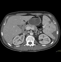 Splenic Infarcts - CTisus CT Scan