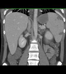 Splenic Infarcts - CTisus CT Scan