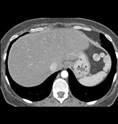 Splenules - CTisus CT Scan