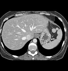 Splenules - CTisus CT Scan