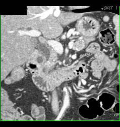 Splenules - CTisus CT Scan