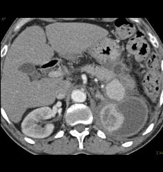 Splenic Artery Pseudoaneurysm Due to Prior Pancreatitis - CTisus CT Scan