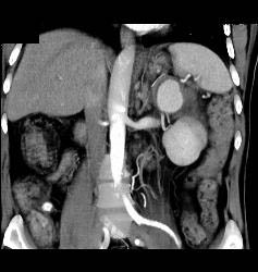 Splenic Artery Pseudoaneurysm Due to Prior Pancreatitis - CTisus CT Scan