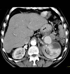 Splenic Artery Pseudoaneurysm Due to Prior Pancreatitis - CTisus CT Scan