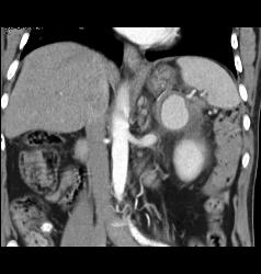 Splenic Artery Pseudoaneurysm Due to Prior Pancreatitis - CTisus CT Scan