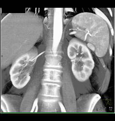 Accessory Spleen Simulates An Islet Cell Tumor of the Pancreatic Tail - CTisus CT Scan