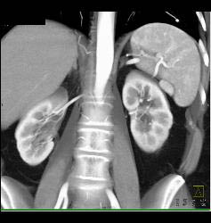 Accessory Spleen Simulates An Islet Cell Tumor of the Pancreatic Tail - CTisus CT Scan