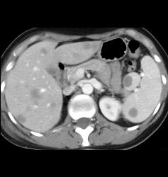 Lymphoma - CTisus CT Scan