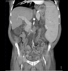 Splenomegaly Due to Portal Hypertension With Varices - CTisus CT Scan