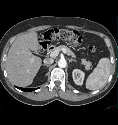 Splenule Near Tail of Pancreas - CTisus CT Scan