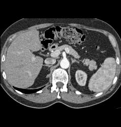 Splenule Near Tail of Pancreas - CTisus CT Scan