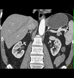 Splenule Near Tail of Pancreas - CTisus CT Scan