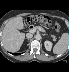 Splenule Near Tail of Pancreas - CTisus CT Scan