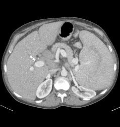 Splenomegaly With Portal Hypertension and Nodes in the Porta - CTisus CT Scan