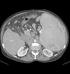 Splenomegaly With Portal Hypertension and Nodes in the Porta - CTisus CT Scan