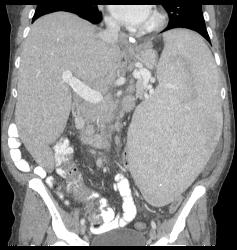 Splenomegaly With Portal Hypertension and Nodes in the Porta - CTisus CT Scan