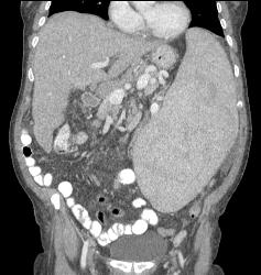 Splenomegaly With Portal Hypertension and Nodes in the Porta - CTisus CT Scan