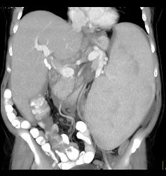 Splenomegaly With Portal Hypertension and Nodes in the Porta - CTisus CT Scan