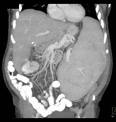 Splenomegaly With Portal Hypertension and Nodes in the Porta - CTisus CT Scan