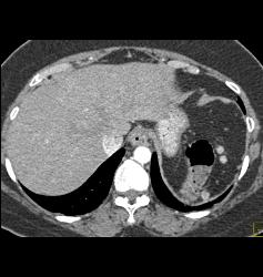 Splenules S/p Splenectomy - CTisus CT Scan