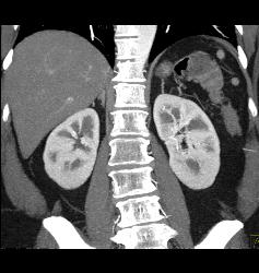 Splenules S/p Splenectomy - CTisus CT Scan