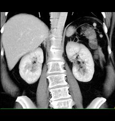 Splenules S/p Splenectomy - CTisus CT Scan