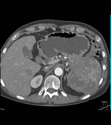 Pancreatic Cancer Invades the Spleen - CTisus CT Scan