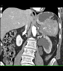 Pancreatic Cancer Invades the Spleen - CTisus CT Scan