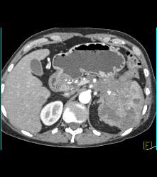 Pancreatic Cancer Invades the Spleen - CTisus CT Scan