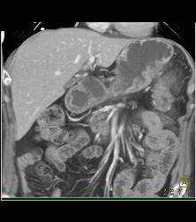 Pancreatic Cancer Invades the Spleen - CTisus CT Scan