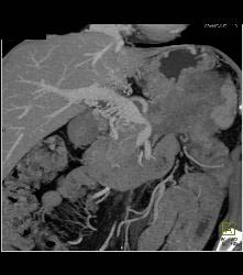 Pancreatic Cancer Invades the Spleen - CTisus CT Scan