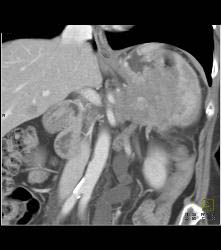 Pancreatic Cancer Invades the Spleen - CTisus CT Scan