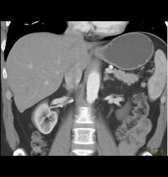 Splenule Near the Splenic Hilum - CTisus CT Scan