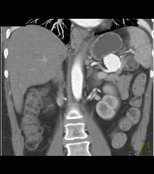 Splenic Artery Aneurysm - CTisus CT Scan