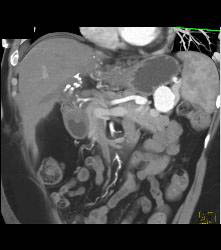 Splenic Artery Aneurysm - CTisus CT Scan