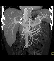 Splenic Artery Aneurysm - CTisus CT Scan