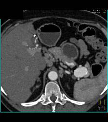 Splenic Artery Aneurysm - CTisus CT Scan