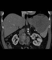 Splenic Lymphoma - CTisus CT Scan