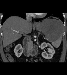 Splenic Lymphoma - CTisus CT Scan