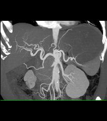 Splenic Lymphoma - CTisus CT Scan