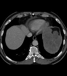 Splenic Lymphoma - CTisus CT Scan