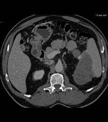 Splenic Lymphoma - CTisus CT Scan