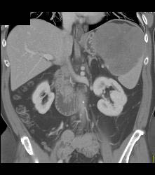 Splenic Lymphoma - CTisus CT Scan