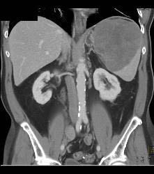 Splenic Hamartoma - CTisus CT Scan